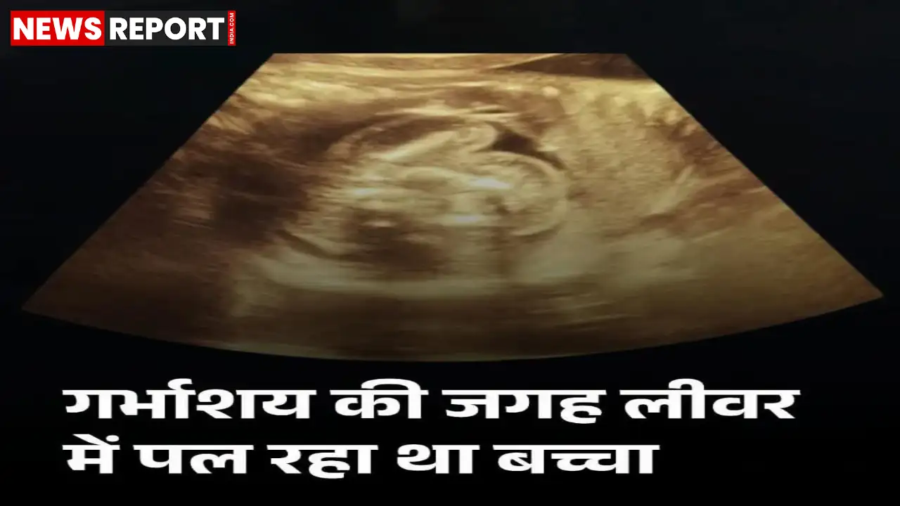 बुलंदशहर में एक महिला के गर्भाशय की बजाय लीवर में 12 हफ्ते का भ्रूण विकसित होने का दुर्लभ मामला सामने आया है।
