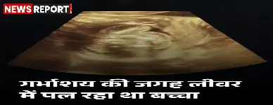 बुलंदशहर: महिला के लीवर में 12 हफ्ते का भ्रूण, दुर्लभ मामला देख डॉक्टर भी हुए हैरान
