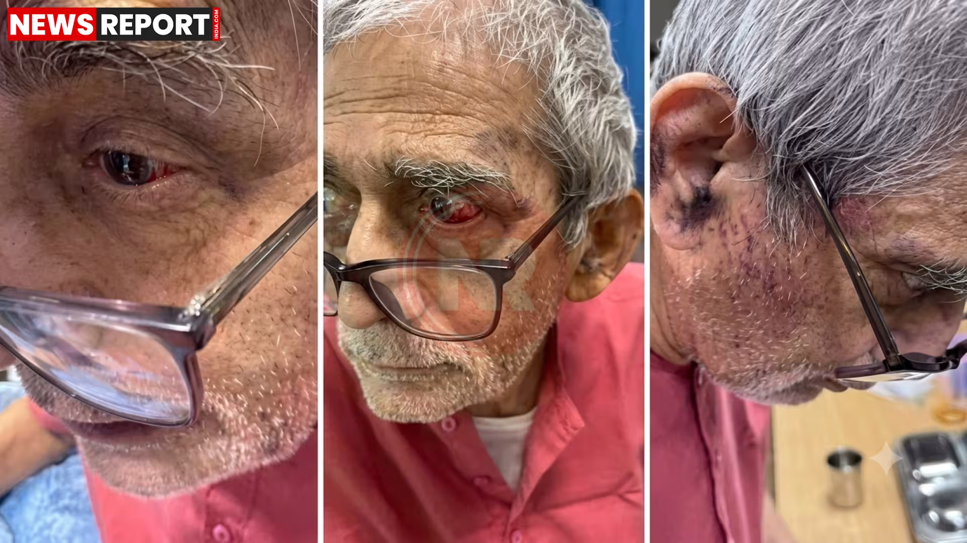 बीएचयू अस्पताल के आईसीयू में भर्ती पद्मश्री प्रो. टीके लहरी
